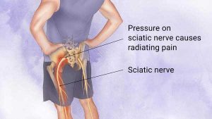 Chiropractic can sometimes help sciatic pain