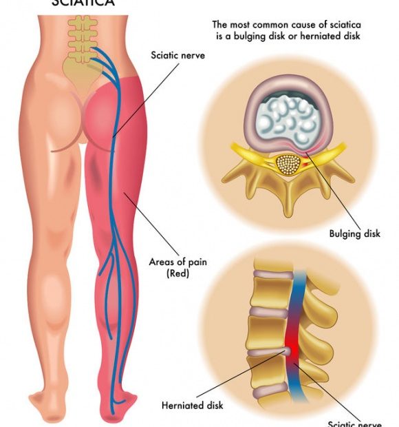 Chiropractic has helped many cases of sciatica