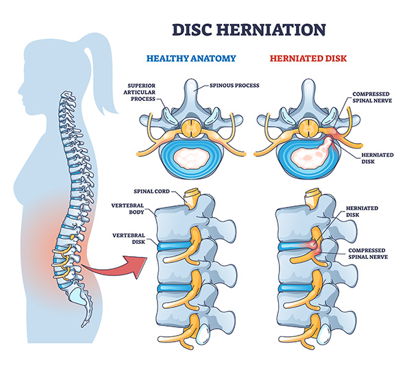 Comparison between a healthy spine and a spine with herniated discs