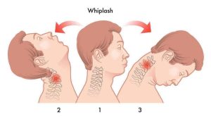 Chiropractic care and whiplash injury